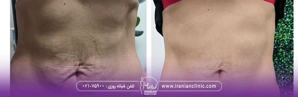 عکس قبل و بعد لاغری شکم با اندولیفت