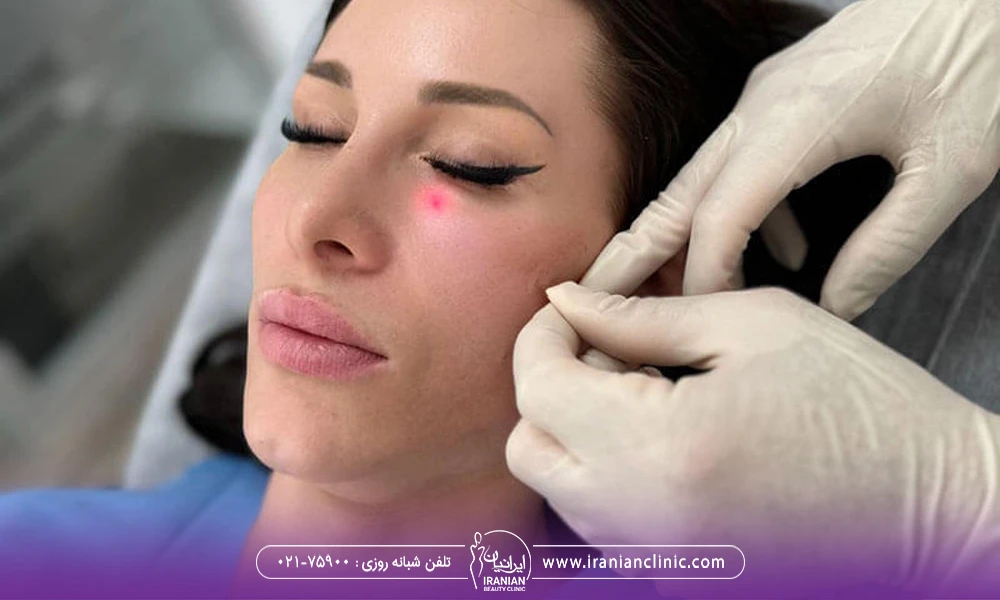 زن که چشمان خود را بسته است و پزشک زیر چشم و گونه او را اندولیفت می کند