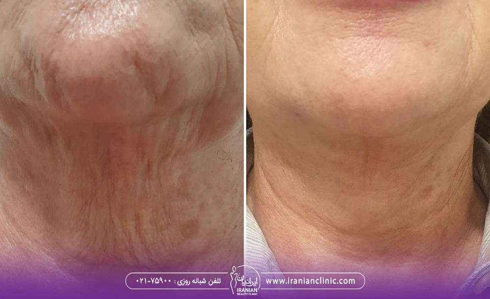 عکس از نتایج اندولیفت گردن