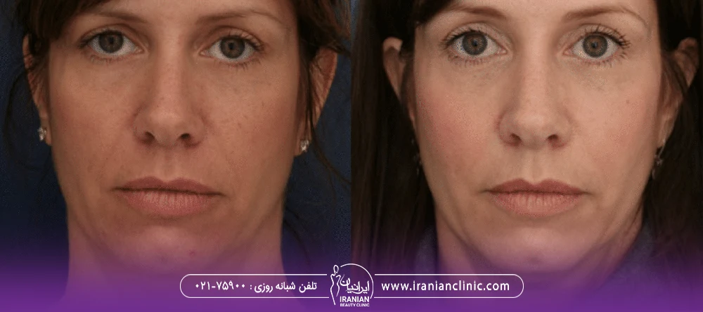 عکس از قبل و بعد خانمی که ابروهای خود را اندولیفت کرده است