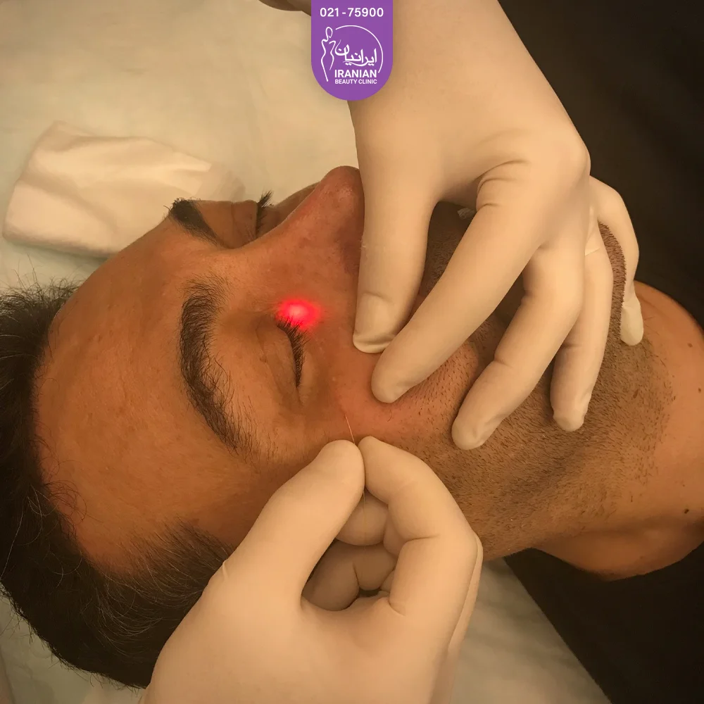 مردی که روی تخت خوابیده و چشمان او بسته است و پزشک زیر چشم او را اندولیفت می کند - اندولیفت پلک