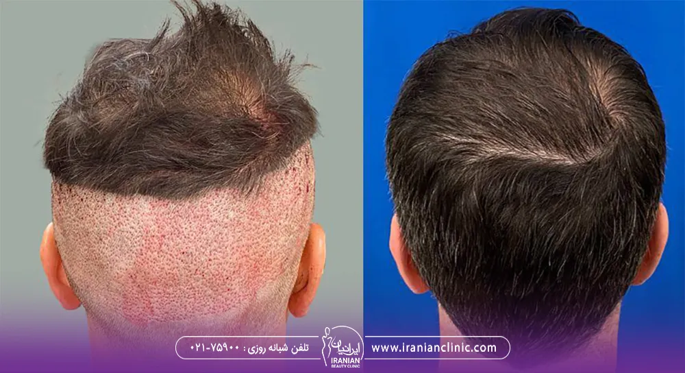 عکس قبل و بعد کاشت مو و عکس ناحیه برداشت فولیکول های مو - بهترین فصل برای کاشت مو