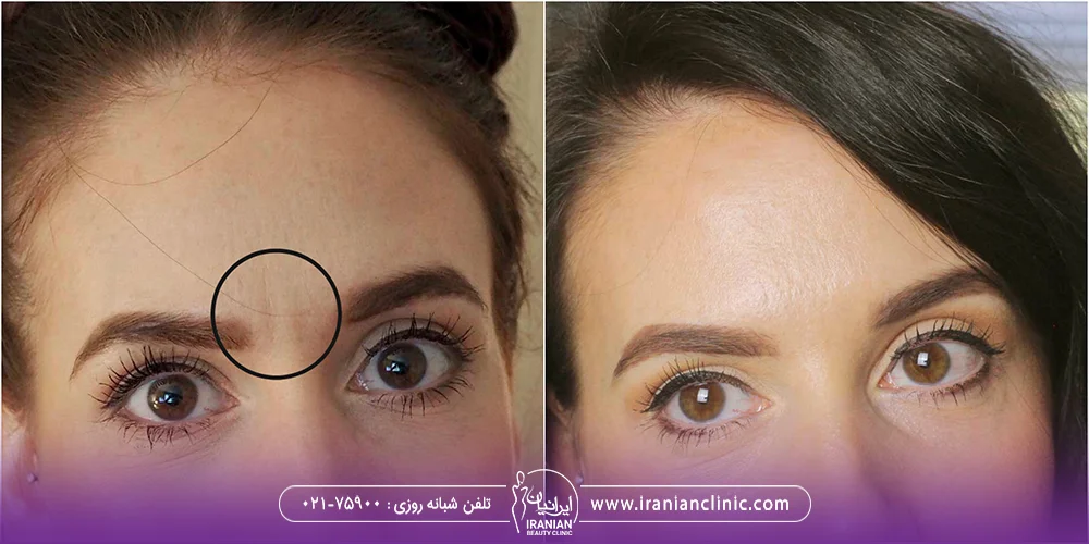 عکس قبل و بعد دختری که خط اخم داشته است و سپس با بوتاکس خط اخم رفع شده است