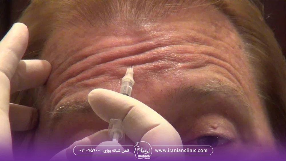 پیشانی مردی که پیشانی خود را منقبض کرده و پزشک به پیشانی او بوتاکس تزریق می کند