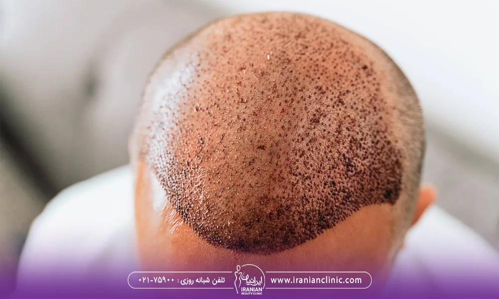 مردی که کاشت مو انجام داده است و روی سر او جای زخم پیوند فولیکول های مو باقی مانده است - کاشت مو از ناحیه تناسلی