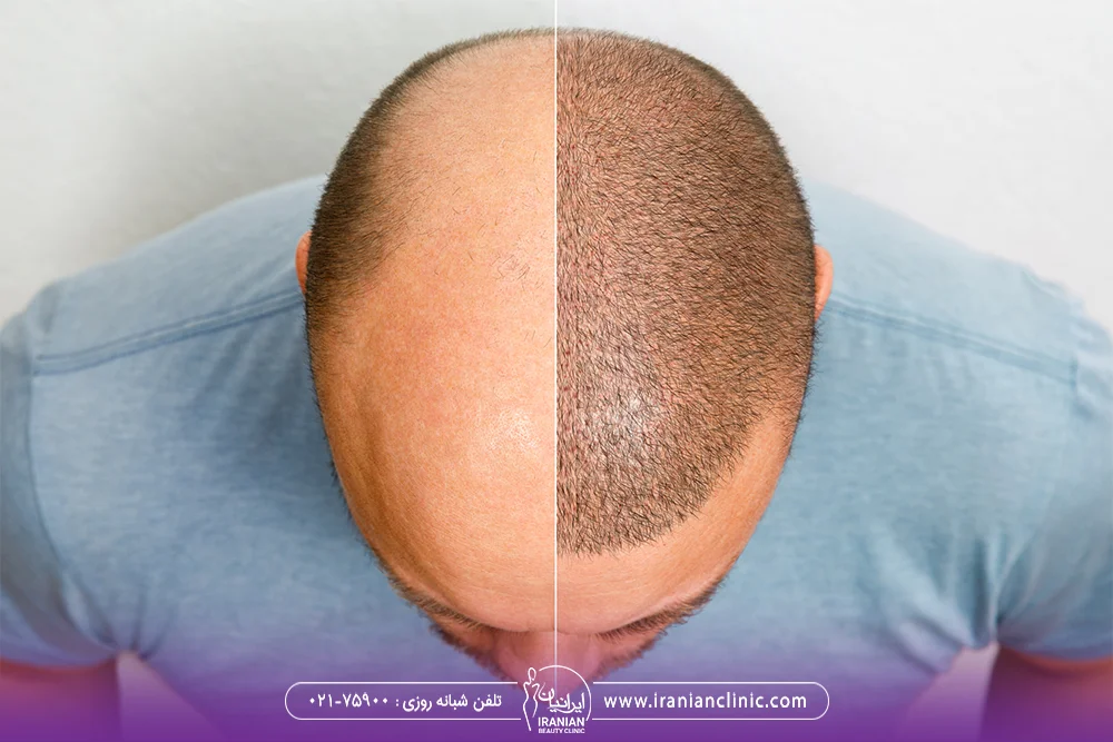 قبل و بعد کاشت موی مرد