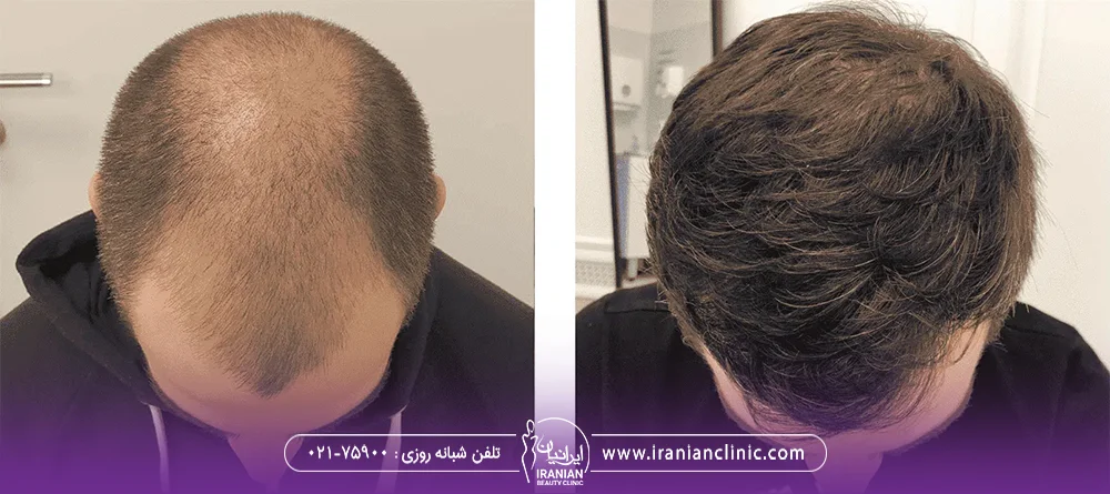 عکس قبل و بعد کاشت موی روی سر مرد جوان