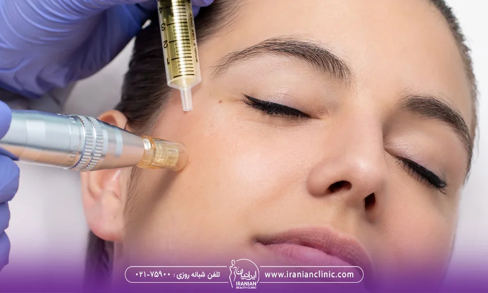 دکتر در حال مزونیدلینگ صورت زن جوان - تیرگی پوست بعد از مزونیدلینگ