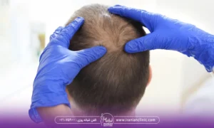 پزشکی که ناحیه طاس سر مرد را معاینه می کند - کاشت مو میکرو ایمپلنت