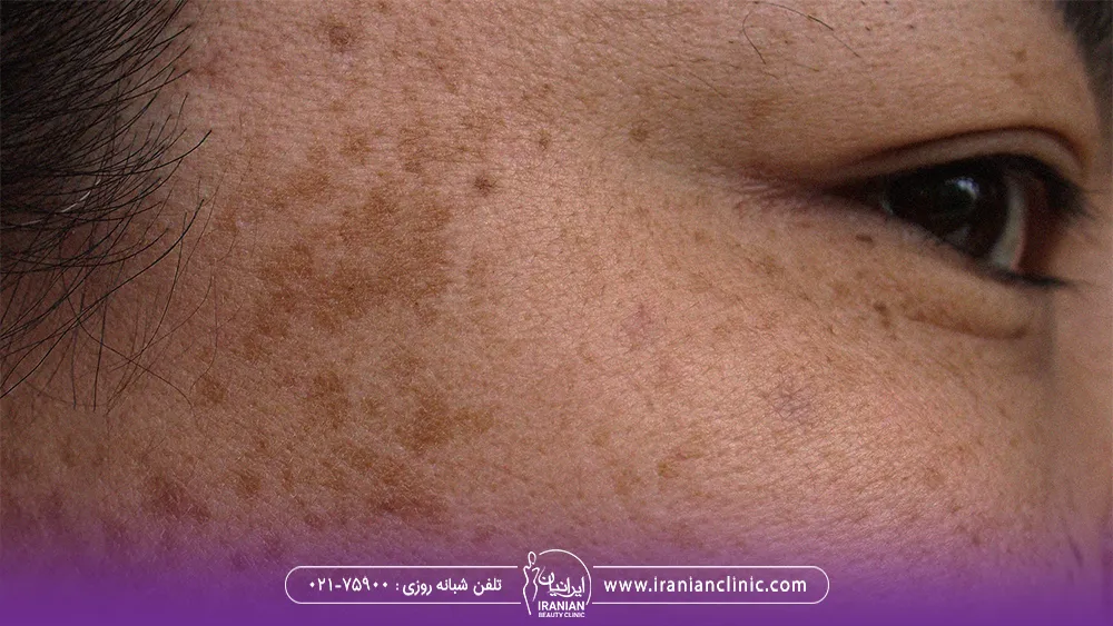 شقیقه و گونه فردی که دچار تیرگی پوست یا هایپرپیگمانتاسیون شده است