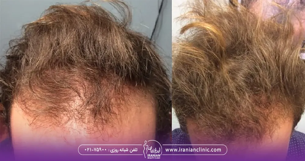 عکس قبل و بعد
