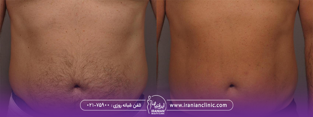 عکس قبل و بعد لیزر موهای زائد شکم