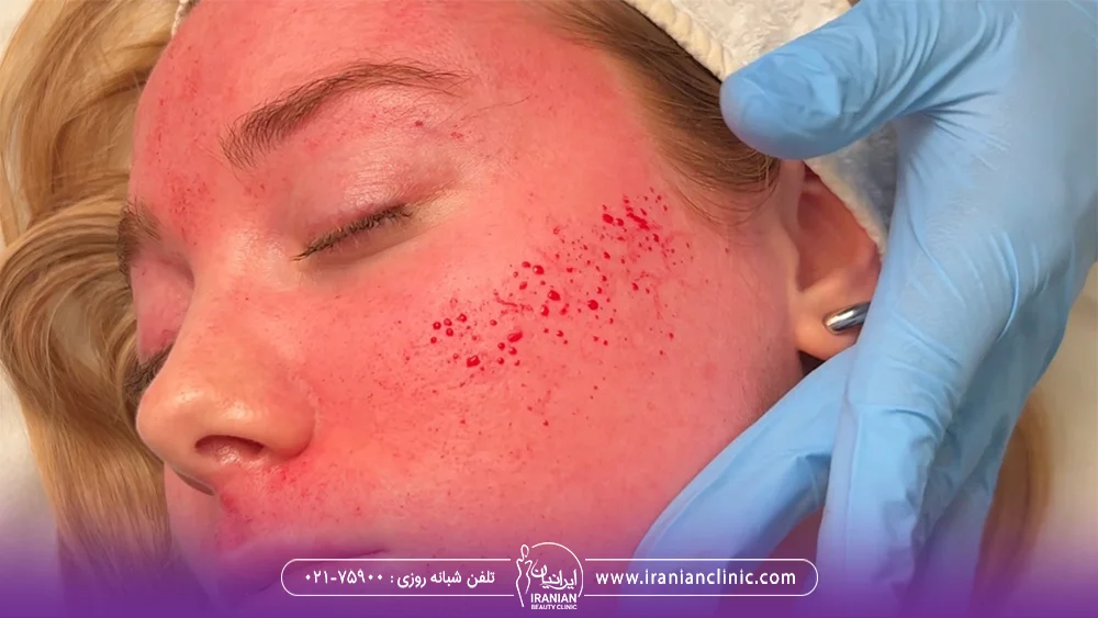 دختر جوان که بعد از میکرونیدلینگ دچار قرمزی پوست شده است و از ناحیه گونه او مقداری خون آمده است