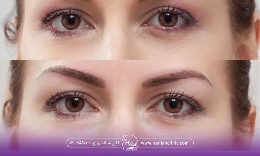 قبل و بعد فردی که مزو تراپی زیر چشم انجام داده است
