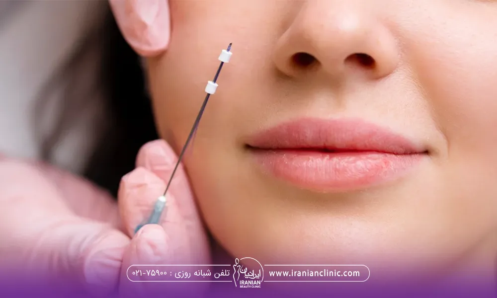 صورت دختر که پزشک نخ لیفت را در کنار صورت او گرفته است