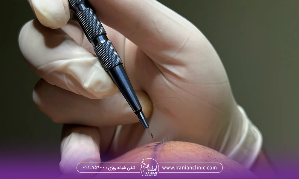 دستان پزشکی که دستکش به دست کرده و در حال انجام کاشت مو به روش Sapphire FUE برای متقاضی می باشد.