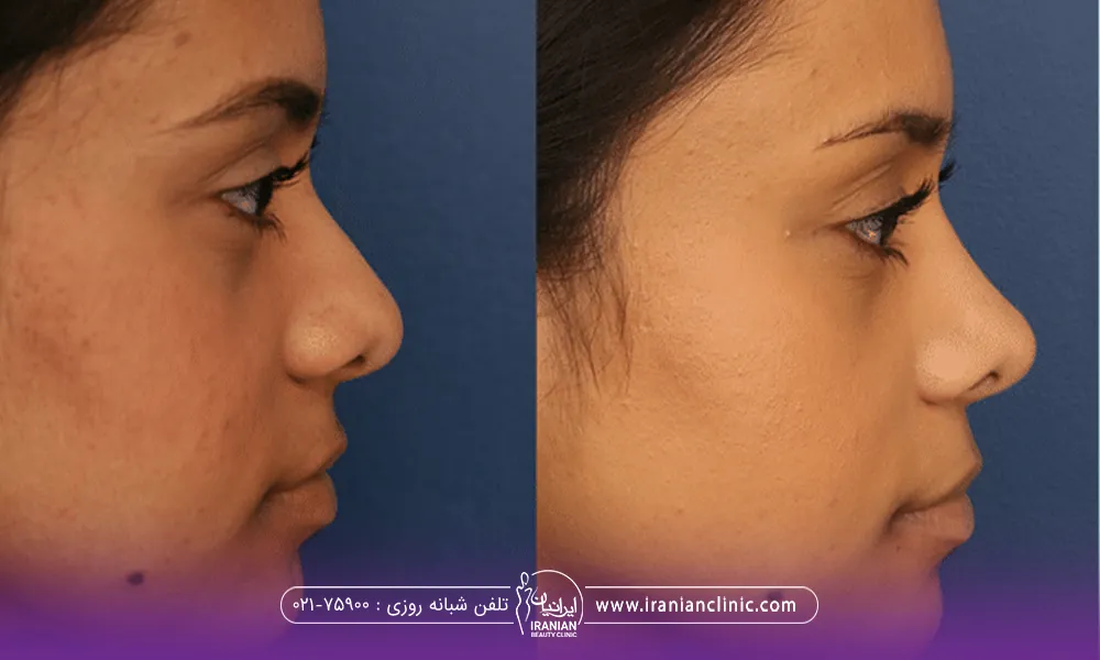 عکس قبل و بعد دختری که لیفت بینی با نخ انجام داده است و نوک بینی او به سمت بالا رفته است