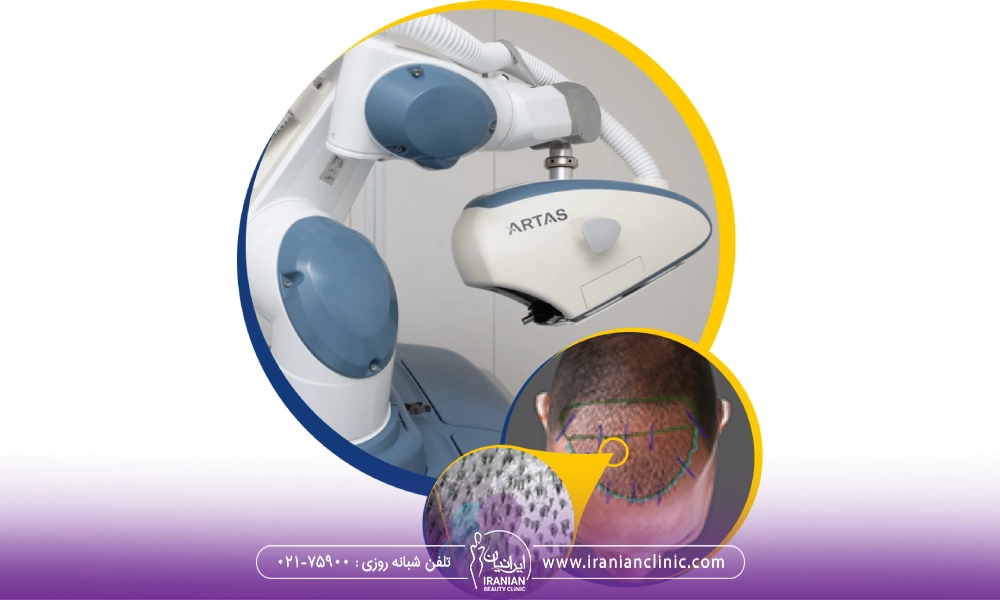 طریقه کار دستگاه کاشت موی رباتیک ARTAS