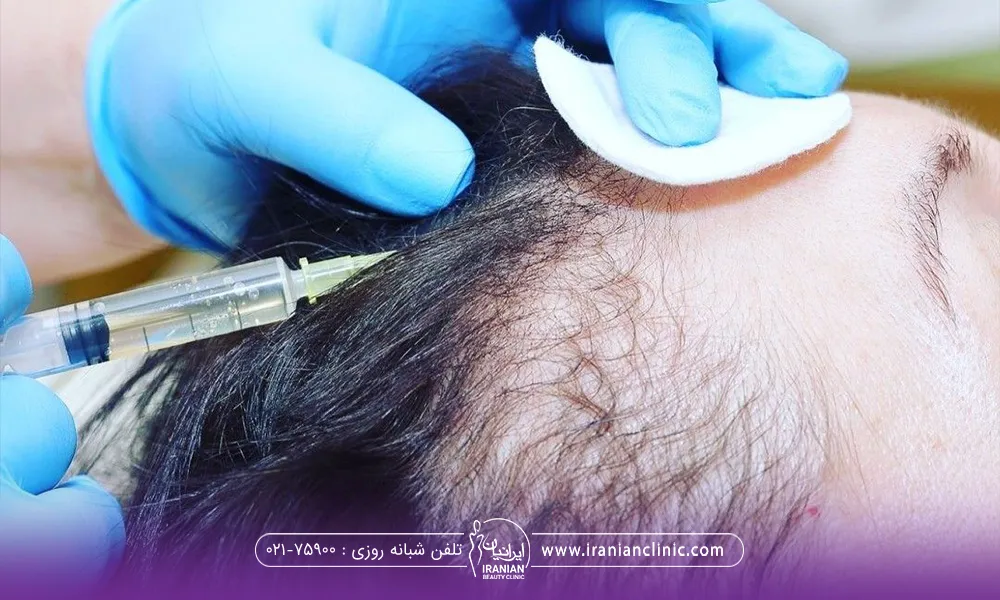 فردی که خوابیده و یک دست دکتر که روی سر فرد است و زیر انگشتش پد دایره ای شکل قرار دارد و یک دست دیگر در حال تزریق به پوست سر است