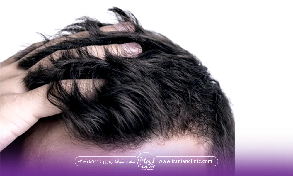 آقایی که انگشتهای دستش را لای موهایش فرو برده است