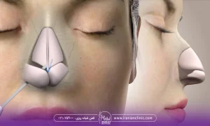 نمای اسنخاوان بینی برای جراحی بینی | هزینه عمل بینی