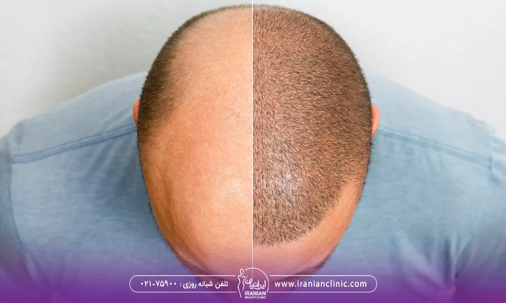 عکس قبل و بعد کاشت مو به روش Sapphire FUE