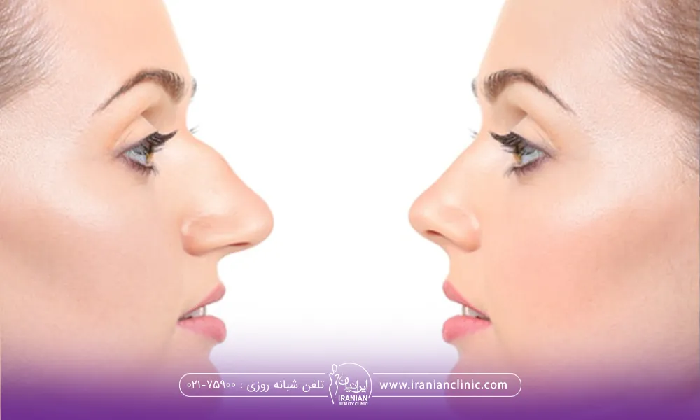 قبل و بعد دختری که عمل بینی انجام داده است