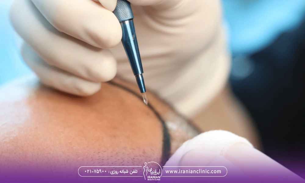 پزشک با علامتگذاری نا حیه کاشت در سر متقاضی در حال انجام کاشت مو به روش Sapphire FUE می باشد.