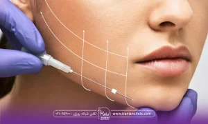 دختری که روی صورت او خط چین به رنگ سفید ترسیم شده است و پزشک نخ لیفت را در کنار صورت او قرار داده است - علائم پاره شدن نخ لیفت صورت​