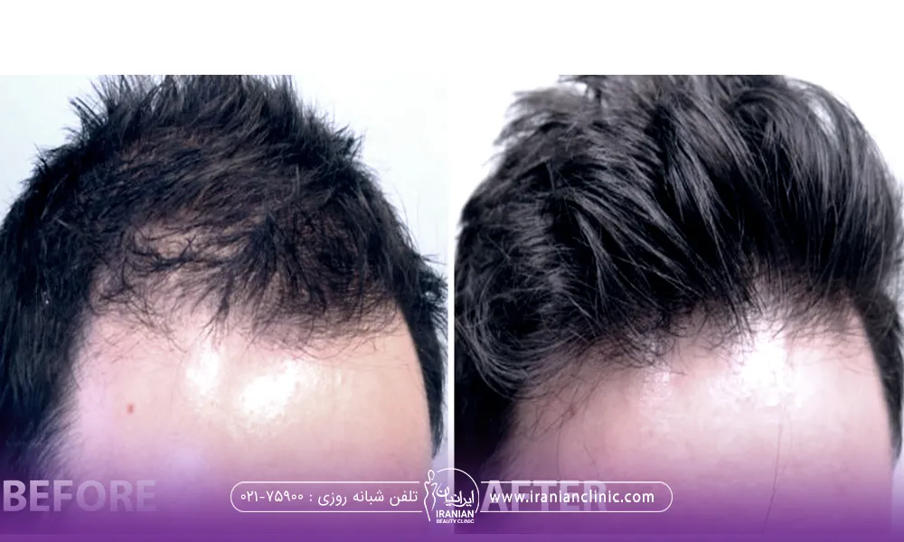 عکس قبل و بعد مردی که هیر فیلر انجام داده است و نتیجه گرفته است