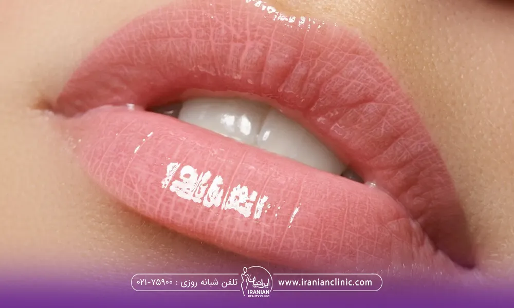 لب هایی حجیم که از هم فاصله دارد و دندان های فرد پیدا است و کمی روژ لب رنگ نود هم زده است
