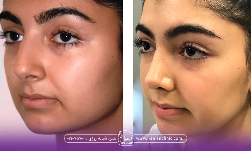 قبل و بعد فردی که عمل بینی گوشتی انجام داده است