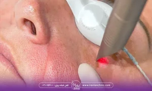 زن که پزشک هندپیس لیزر فوتونا را روی صورت او قرار داده است - عوارض لیزر فوتونا