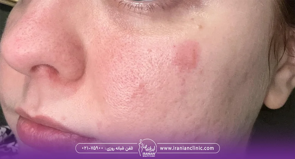 زن که صورت او و روی گونه او دچار قرمزی و التهاب شده است