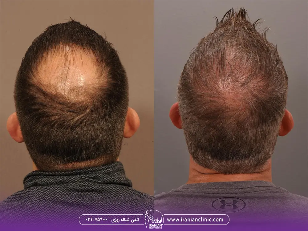 عکس قبل و بعد از پشت سر مرد که در فرق سر طاس بوده و در آن ناحیه کاشت انجام داده است