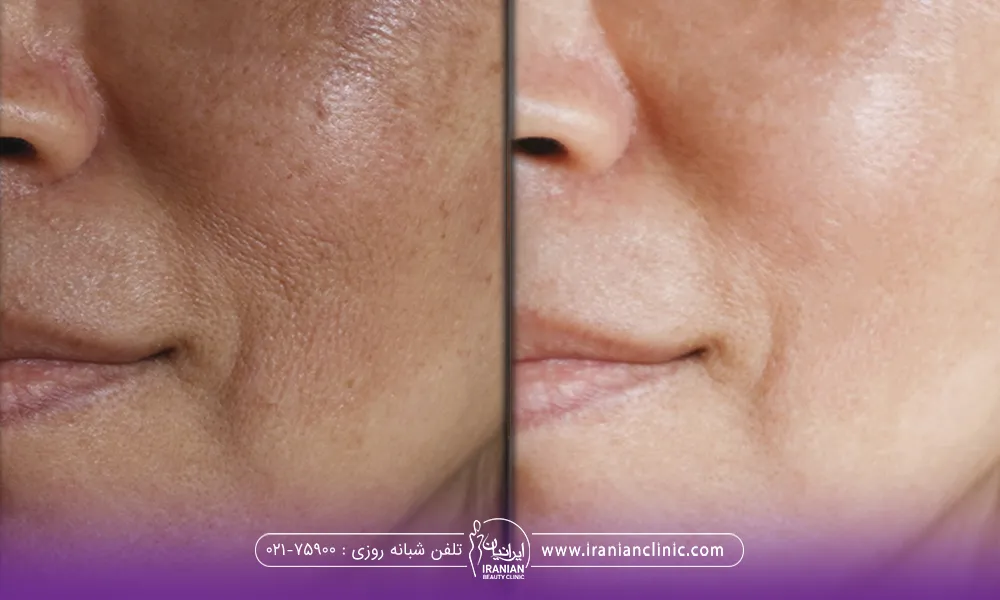 عکس قبل و بعد جوانسازی صورت زن با تزریق مزوژل