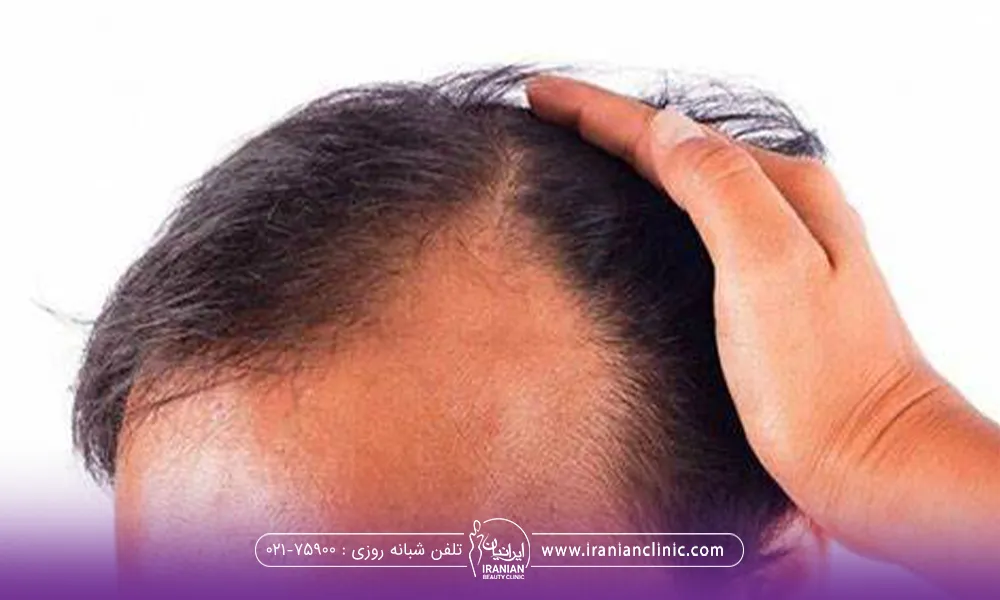 مردی که قسمت شقیقه اش خالی شده و دستش لای موهایش است