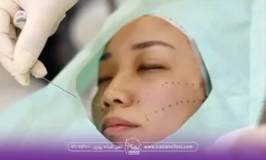 زنی که با چشمان بسته دراز کشیده است در حالی که پزشک نخ لیفت را وارد صورت او می کند - عوارض عمل لیفت صورت