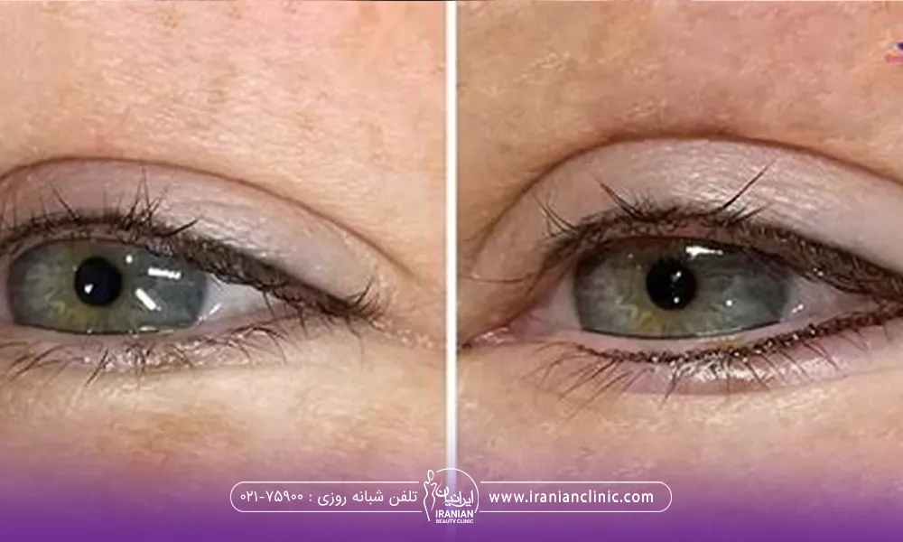 عکس قبل و بعد دختری که عمل بلفاروپلاستی انجام داده است