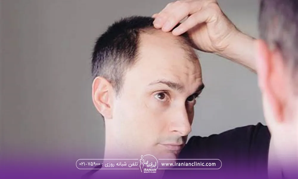 مردی که صورت خود را در آینه می بیند و موهای جلوی سر و شقیقه او کم پشت شده است - کاشت مو شقیقه