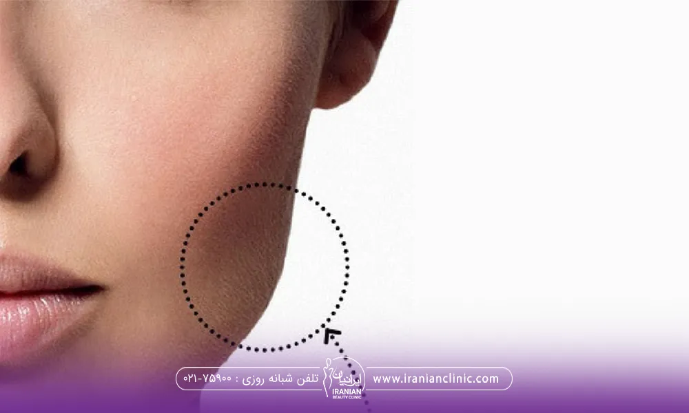 تصویر صورت یک دختر که فک او زاویه دارد و ای زاویه با یک دایره در عکس مشخص شده است