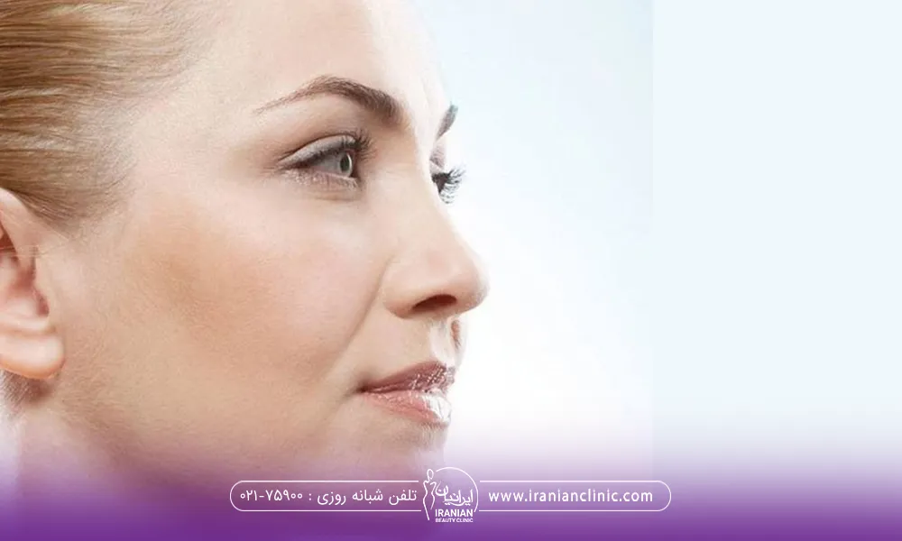 عکس نیم رخ از صورت زن که روی صورت او خط خنده مشخص شده است