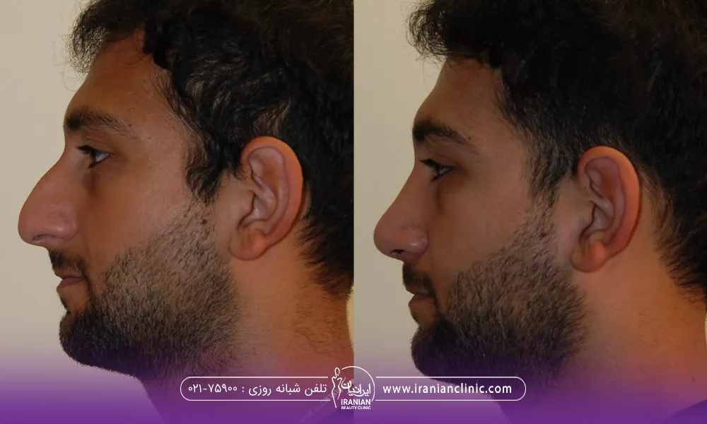 عکس قبل و بعد آقایی که تزریق چربی به چانه کرده است