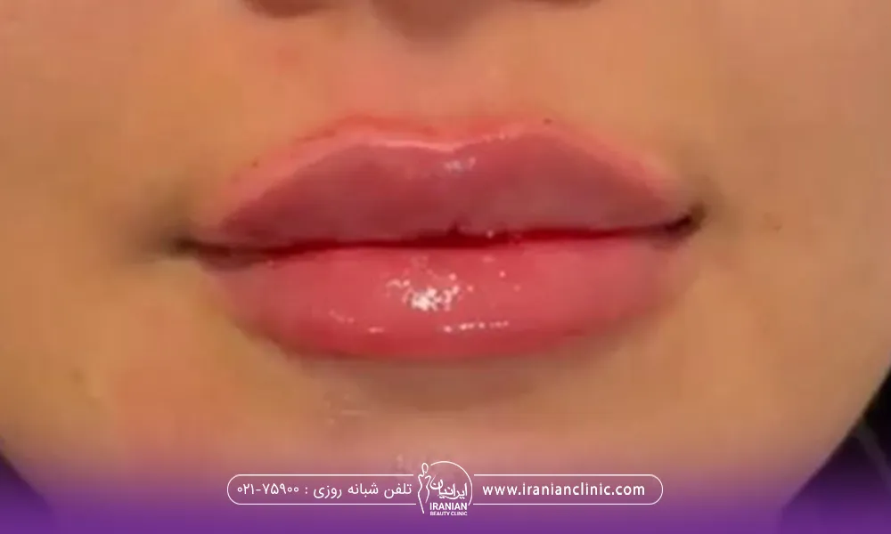 لب های بزرگ خانمی که تزریق ژل انجام داده است
