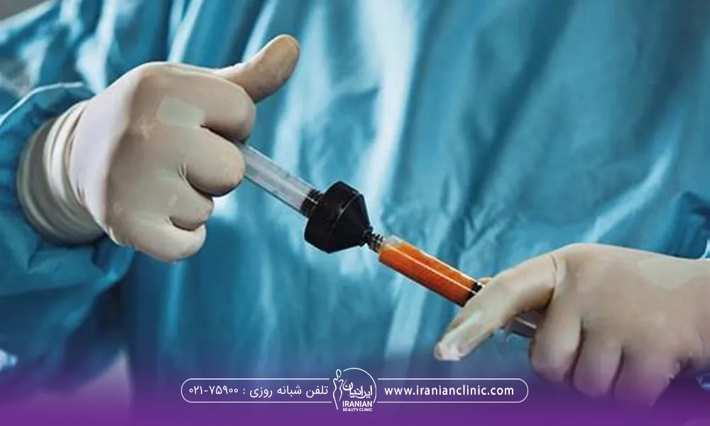 پزشکی که چربی استخراج شده را وارد سرنگ می کند