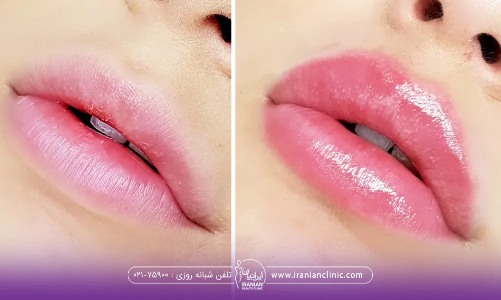 عکس قبل و بعد دختری که تزریق ژل انجام داده است