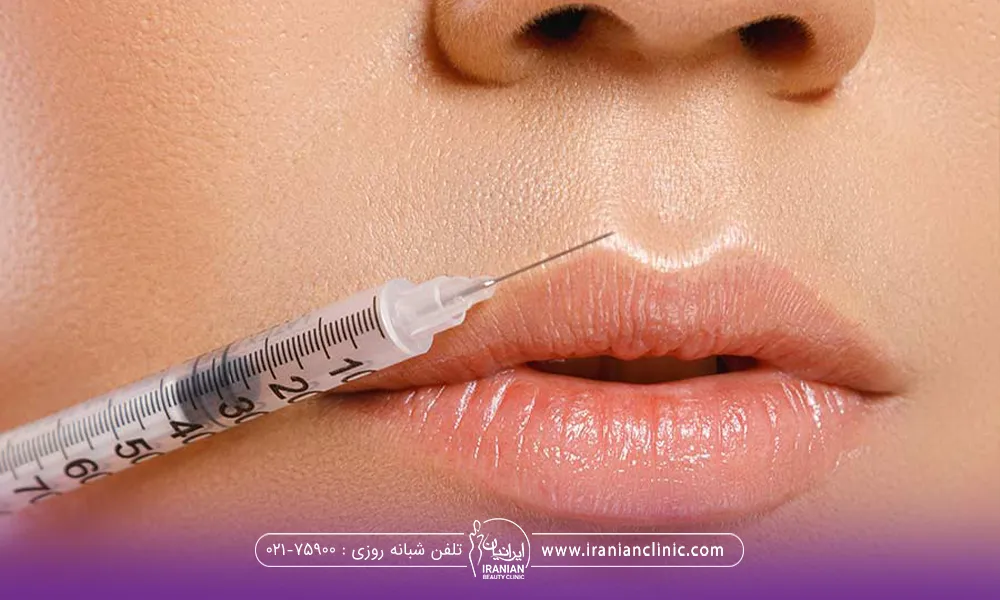 لب فردی که روی آن سرنگ برای تزریق ژل لب قرار گرفته است