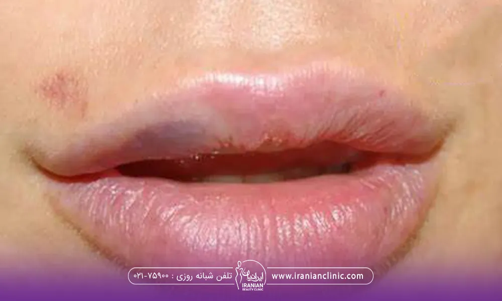 لب فردی که پس از تزریق کبود شده است