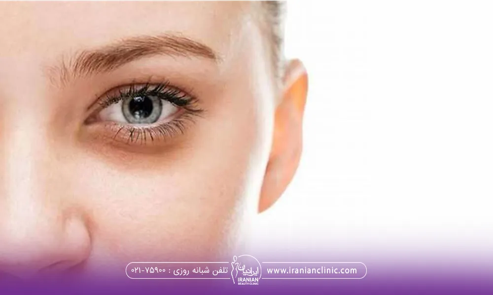 زن جوان با چشم سبز که زیر چشم او گود و تیره شده است
