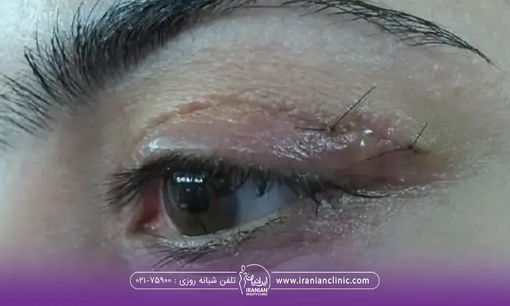 اسکار بخیه گوشه چشم زن بعد از بلفاروپلاستی - عوارض بلفاروپلاستی
